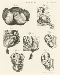 Obstétrique, illustration de 